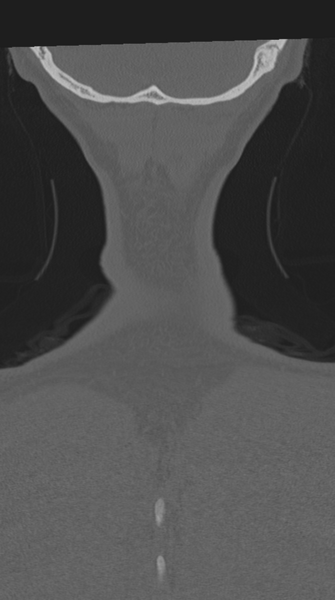 File:Cervical intercalary bone (Radiopaedia 35211-36748 Coronal bone window 80).png