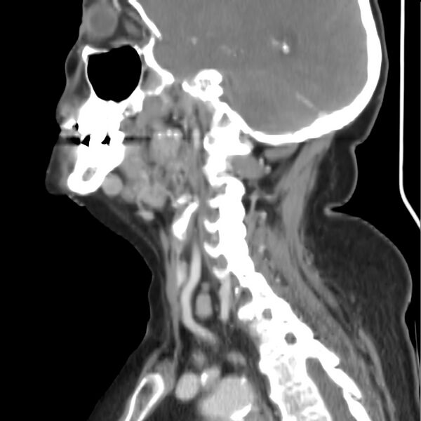 File:Cervical lymphadenopathy- cause unknown (Radiopaedia 22420-22457 D 25).jpg