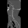 Cervical spine fractures with vertebral artery dissection (Radiopaedia 32135-33078 Sagittal bone window 11).jpg