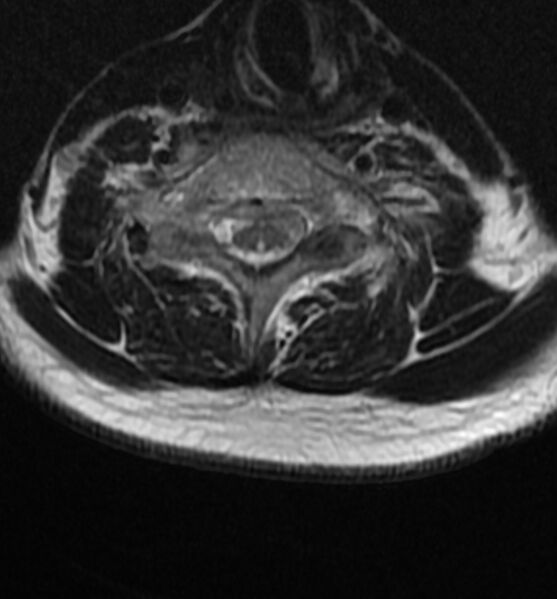 File:Cervical spondylodiscitis (Radiopaedia 81362-95110 Axial T2 14).jpg