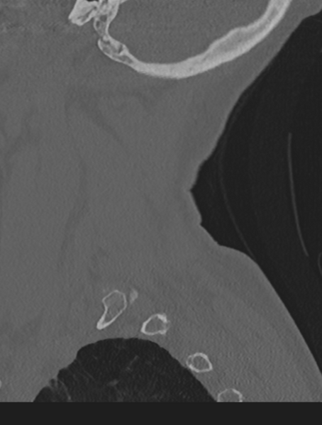 File:Cervical spondylolysis (Radiopaedia 49616-54811 Sagittal bone window 63).png