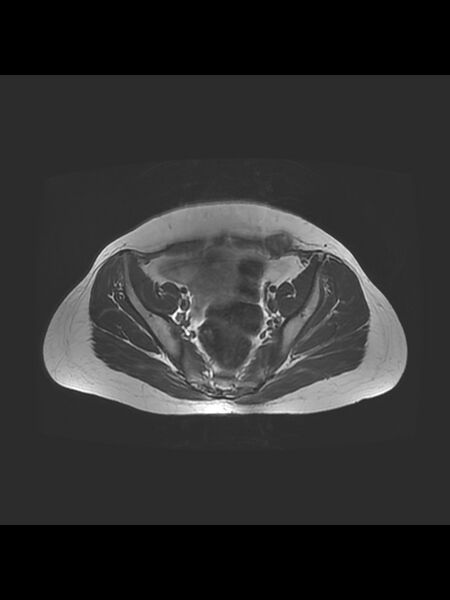 File:Cesarean section scar endometrioma (Radiopaedia 56569-63297 Axial T2 10).jpg