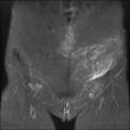 Cesarian section scar endometriosis (Radiopaedia 66520-75799 Coronal STIR 4).jpg