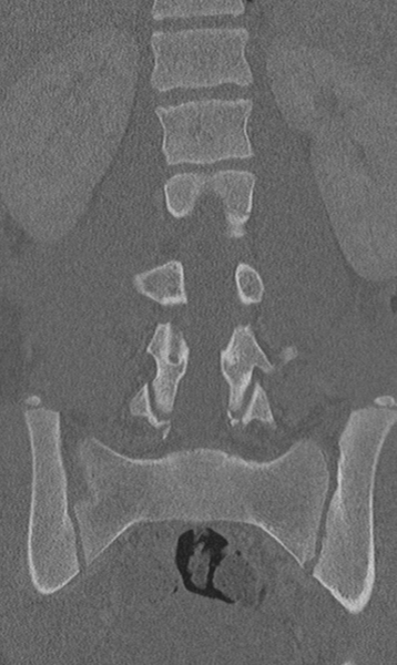 File:Chance fracture (Radiopaedia 40360-42912 Coronal bone window 38).png
