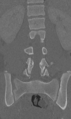 Chance fracture (Radiopaedia 40360-42912 Coronal bone window 38).png
