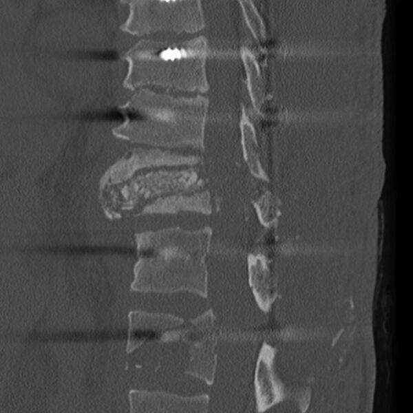 File:Charcot joint - spine (Radiopaedia 7198-8156 Sagittal bone window 1).jpg