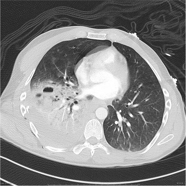 File:Chest and abdomen multi-trauma (Radiopaedia 26294-26425 lung window 64).jpg