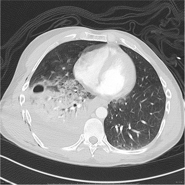 File:Chest and abdomen multi-trauma (Radiopaedia 26294-26425 lung window 70).jpg