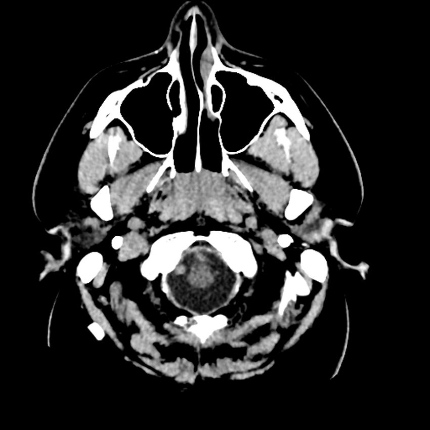 Chiasmatic-hypothalamic juvenile pilocytic astrocytoma (Radiopaedia 78533-91237 Axial non-contrast 8).jpg