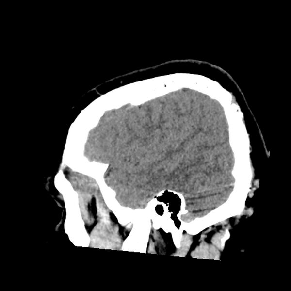 File:Chiasmatic-hypothalamic juvenile pilocytic astrocytoma (Radiopaedia 78533-91237 B 50).jpg