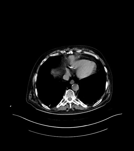File:Cholangiocarcinoma with cerebral metastases (Radiopaedia 83519-98629 Axial non-contrast 5).jpg