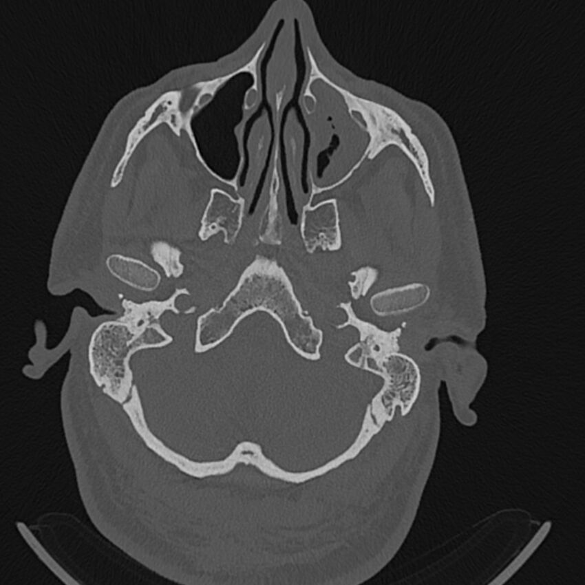 Cholesteatoma (Radiopaedia 68176-77673 Axial bone window 9).jpg