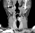 Chondrosarcoma - larynx (Radiopaedia 4588-6698 B 4).jpg