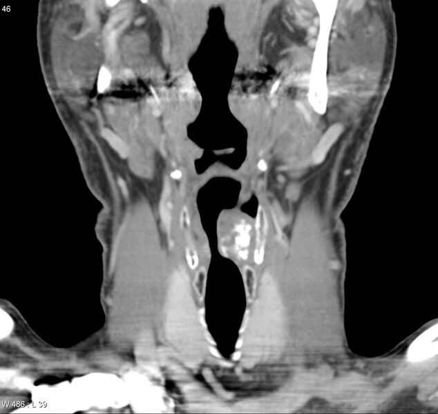 File:Chondrosarcoma - larynx (Radiopaedia 4588-6698 B 4).jpg