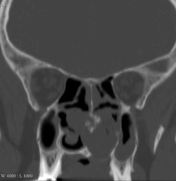 File:Chondrosarcoma - nasal septum (Radiopaedia 5395-7150 Coronal non-contrast 1).jpg