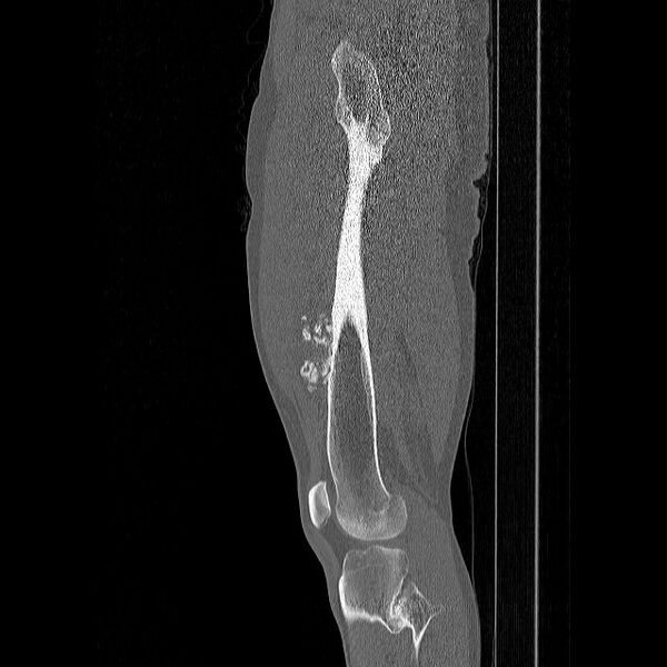 File:Chondrosarcoma arising from exostosis (Radiopaedia 59996-67507 Sagittal bone window 2).jpg