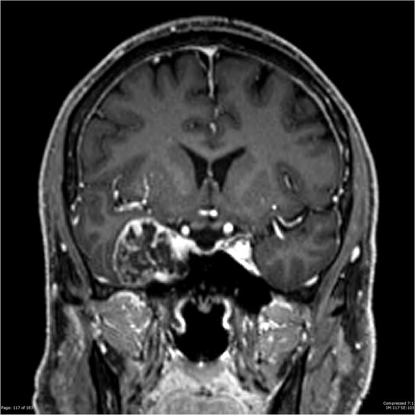 File:Chondrosarcoma of skull base- grade II (Radiopaedia 40948-43654 Coronal T1 C+ 28).jpg