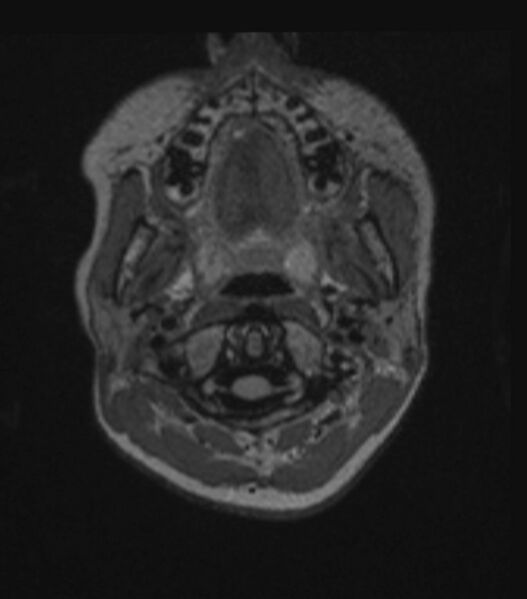 File:Choroid plexus carcinoma (Radiopaedia 91013-108553 Axial FLAIR C+ 56).jpg