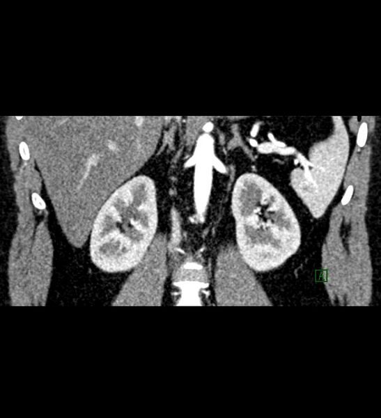 File:Chromophobe renal cell carcinoma (Radiopaedia 84286-99573 E 52).jpg