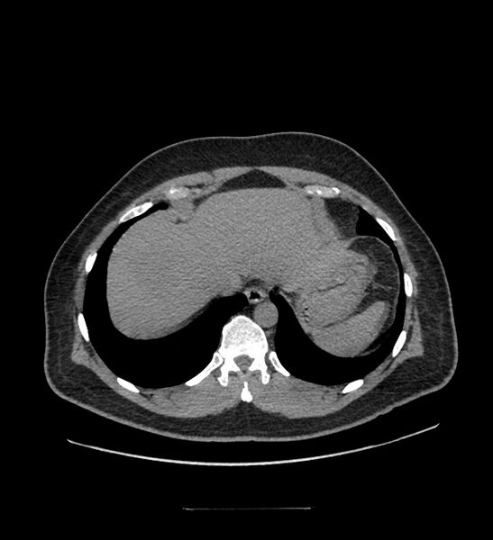 File:Chromophobe renal cell carcinoma (Radiopaedia 84337-99644 Axial non-contrast 10).jpg