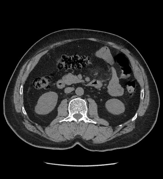 File:Chromophobe renal cell carcinoma (Radiopaedia 86879-103083 Axial non-contrast 44).jpg