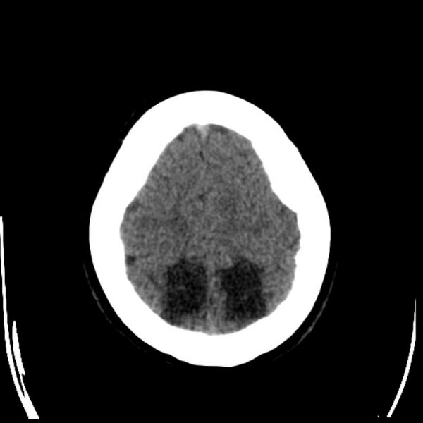 File:Chronic bilateral occipital lobe infarcts (Radiopaedia 31276-31996 Axial non-contrast 36).jpg