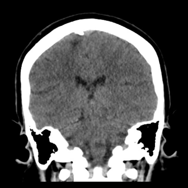 File:Chronic bilateral occipital lobe infarcts (Radiopaedia 31276-31996 Coronal non-contrast 30).jpg