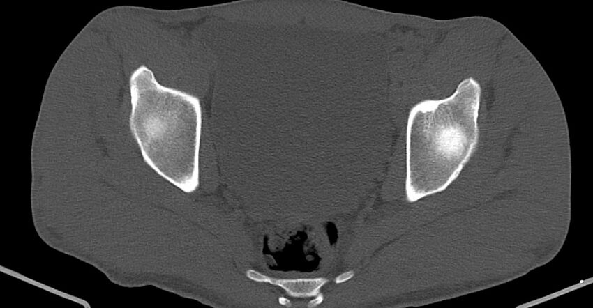 Chronic osteomyelitis (with sequestrum) (Radiopaedia 74813-85822 Axial non-contrast 28).jpg