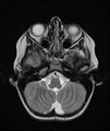 Chronic reactive multifocal osteomyelitis (CRMO) - mandible (Radiopaedia 56405-63069 Axial T2 22).jpg