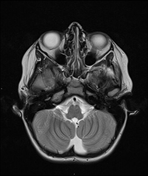 File:Chronic reactive multifocal osteomyelitis (CRMO) - mandible (Radiopaedia 56405-63069 Axial T2 22).jpg