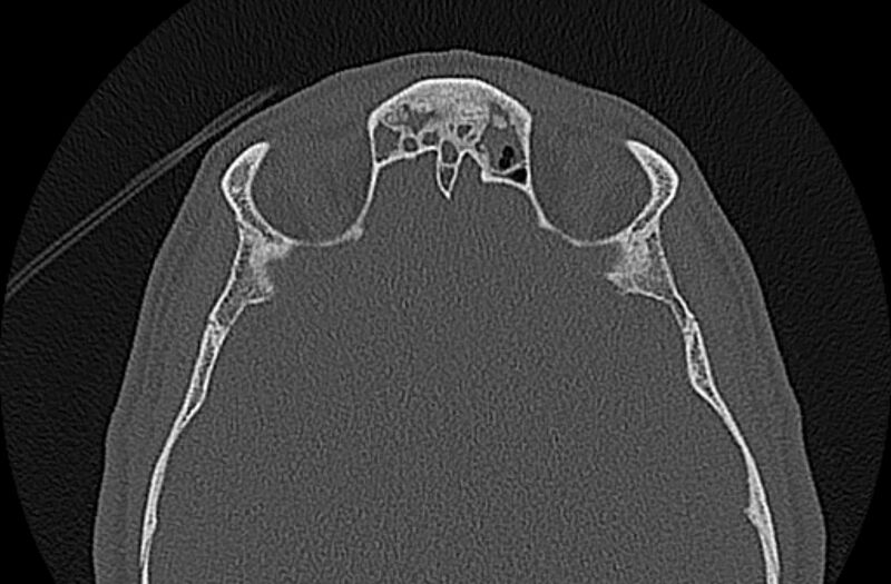 File:Chronic rhinosinusitis (Radiopaedia 65079-74075 Axial bone window 69).jpg