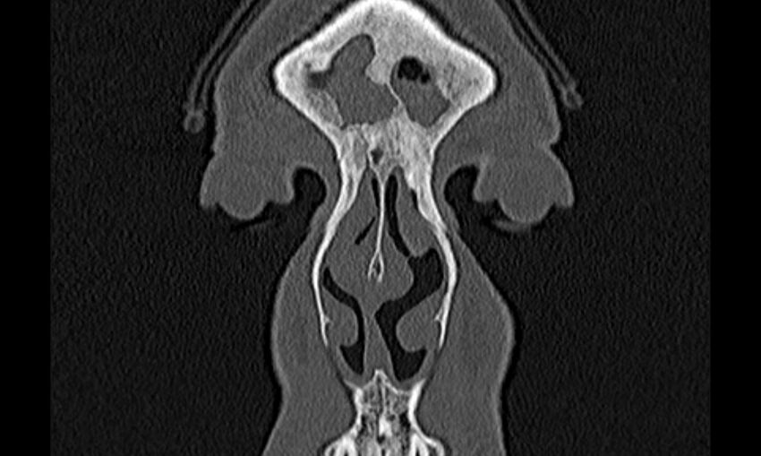 Chronic rhinosinusitis (Radiopaedia 65079-74075 Coronal bone window 4).jpg
