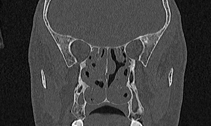File:Chronic rhinosinusitis (Radiopaedia 65079-74075 Coronal bone window 52).jpg