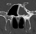 Chronic sphenoidal sinusitis and osteomyelitis (Radiopaedia 14037).jpg