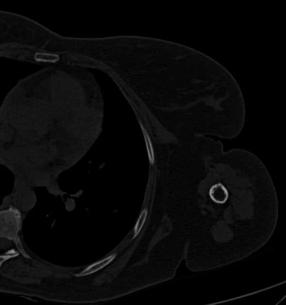 File:Clear cell chondrosarcoma - humerus (Radiopaedia 63104-71612 Axial bone window 93).jpg