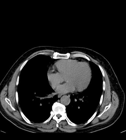File:Clear cell renal cell carcinoma (Radiopaedia 85006-100539 Axial non-contrast 6).jpg