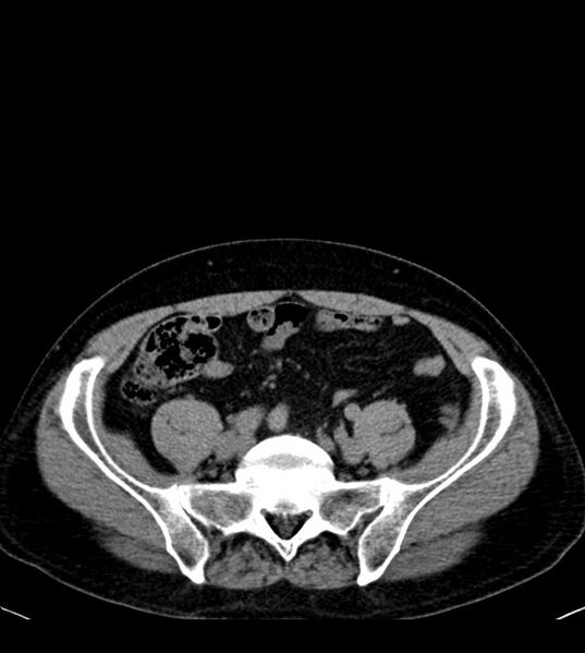 File:Clear cell renal cell carcinoma (Radiopaedia 85006-100539 Axial non-contrast 65).jpg