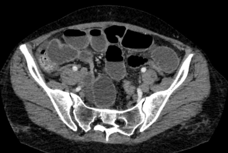 File:Closed loop small bowel obstruction (Radiopaedia 71211-81508 A 118).jpg