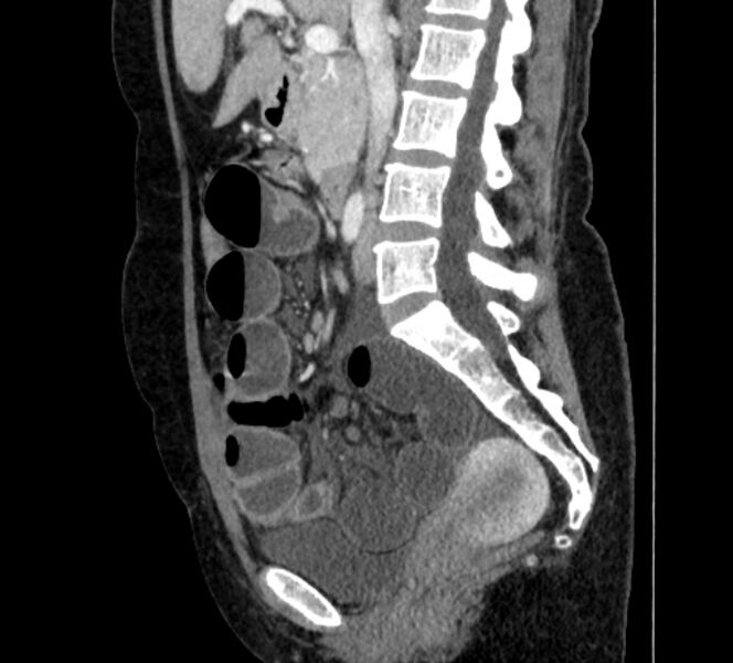 File:Closed loop small bowel obstruction (Radiopaedia 71211-81508 C 68).jpg
