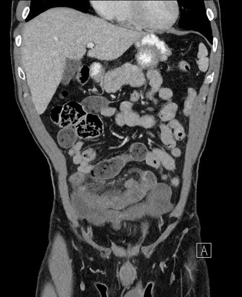 File:Closed loop small bowel obstruction - internal hernia (Radiopaedia 57806-64778 A 36).jpg