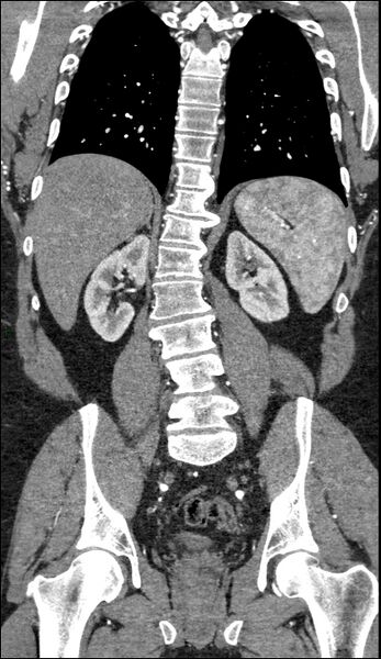 File:Coarctation of the aorta (Radiopaedia 74632-88521 B 166).jpg