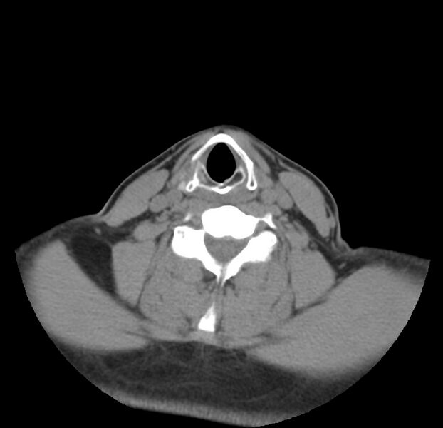 File:Colloid cyst of thyroid (Radiopaedia 22897-22923 Axial non-contrast 35).jpg