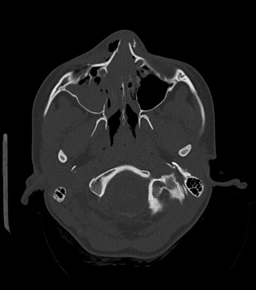 File:Nasoorbitoethmoid fracture (Radiopaedia 90044-107205 Axial bone window 67).jpg