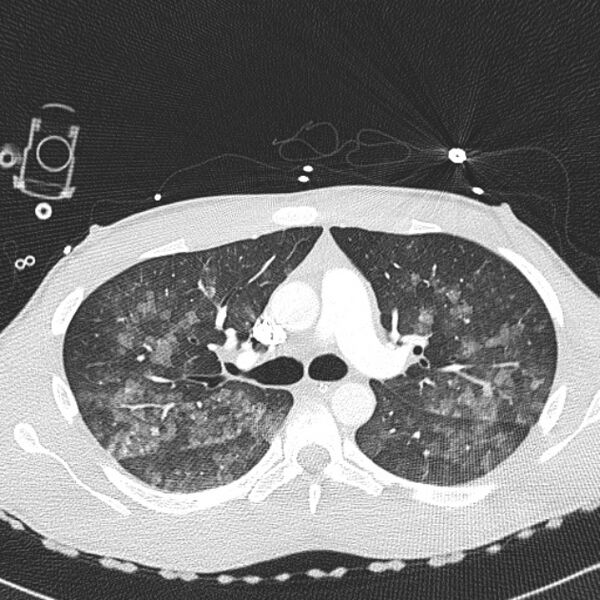File:Near drowning (pulmonary edema) (Radiopaedia 24685-24958 lung window 13).jpg