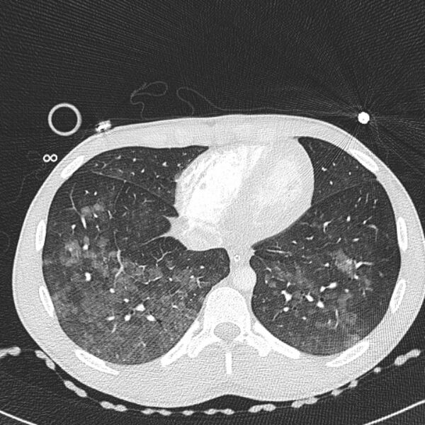 File:Near drowning (pulmonary edema) (Radiopaedia 24685-24958 lung window 62).jpg