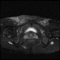 Necrotizing epididymo-orchitis with intra-testicular abscess (Radiopaedia 29397-29860 Axial T2 fat sat 4).jpg
