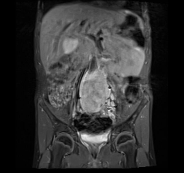 File:Neuroblastoma (Radiopaedia 6010-7518 Coronal T1 fat sat 6).jpg