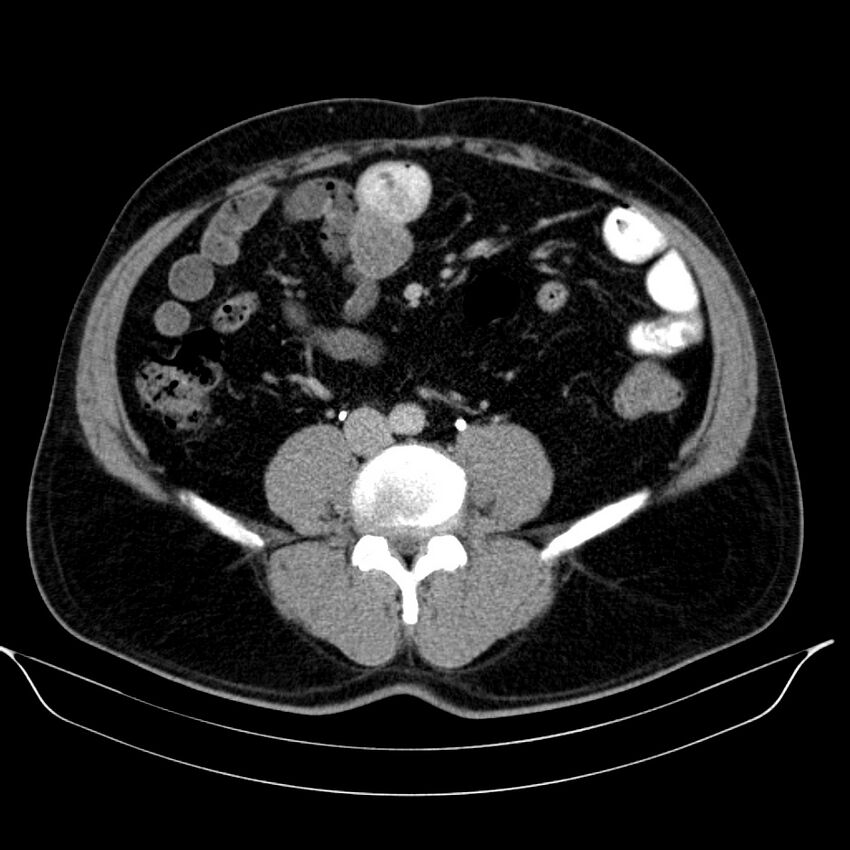 Neuroendocrine tumor of head of pancreas (Radiopaedia 57538-64502 D 52).jpg