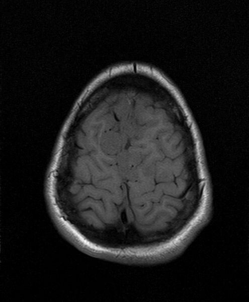 File:Neurofibromatosis type 2 (Radiopaedia 66211-75401 Axial T1 24).jpg