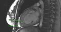 Non-compaction of the left ventricle (Radiopaedia 38868-41063 2 CH SSFP 1).jpg